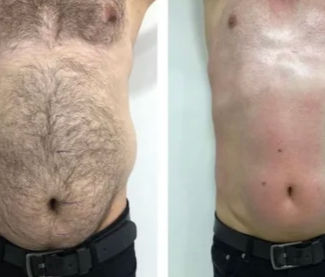 Before-and-after image showing the stomach of a person. Left: hair and excess fat visible