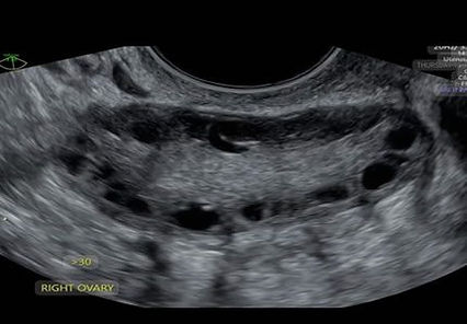 Ovarian cyst evaluation