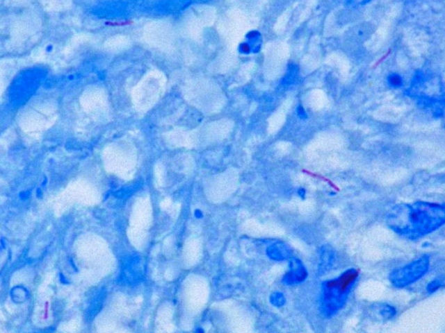 Immagine al microscopio del Mycobacterium tuberculosis