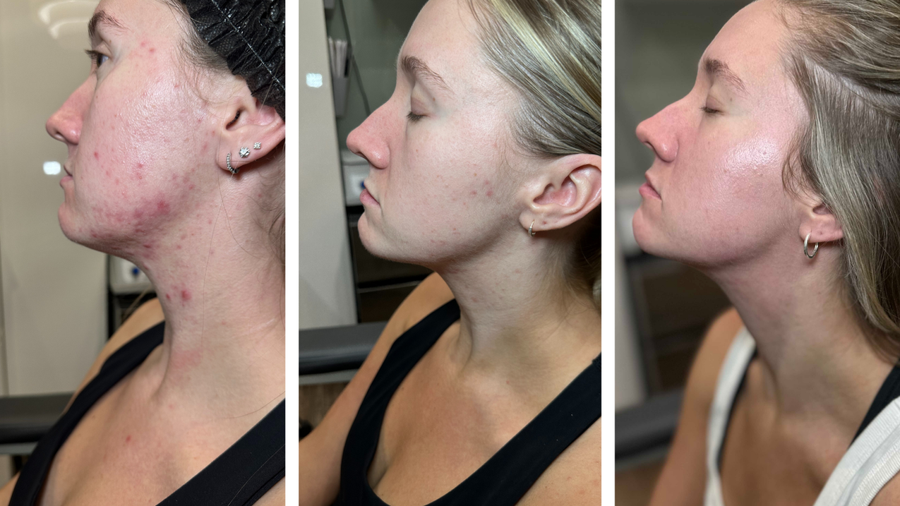 Acne treatment results with aerolase laser, face reality acne skincare and peels at with love beauty in Bel Air Maryland