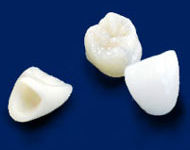 セラミッククラウン(被せ物)