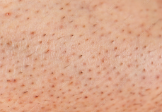 Why do I have ingrown hairs?