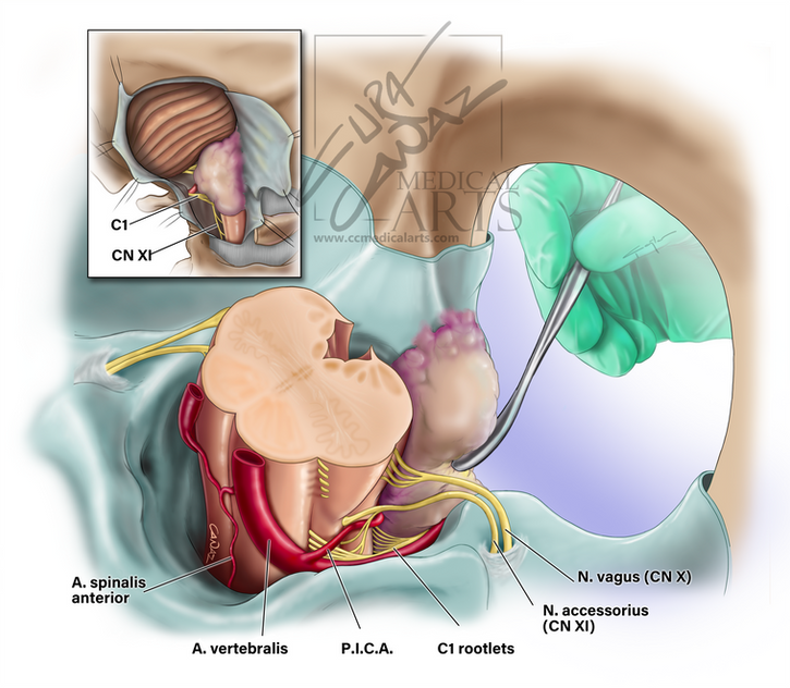 Foramen Magnum Meningiom