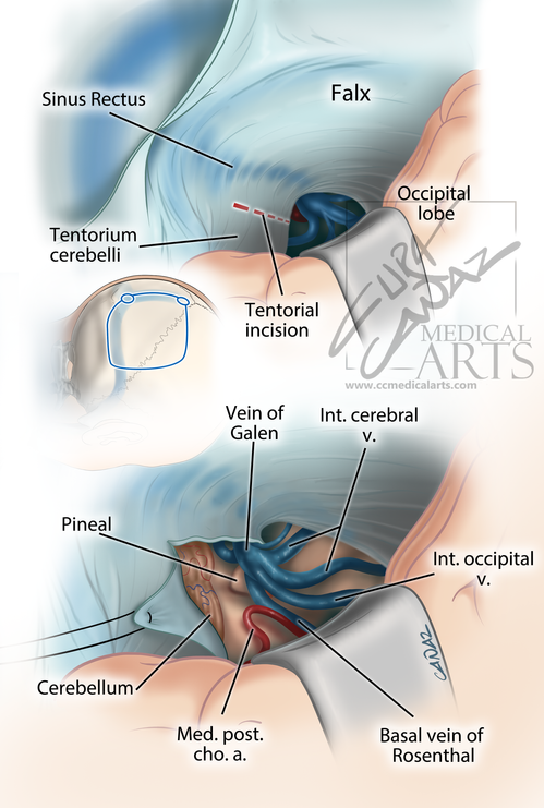 Suboksipital Transtentorial