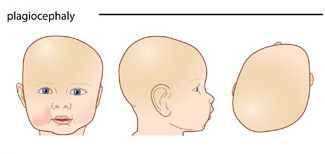 What is Plagiocephaly?