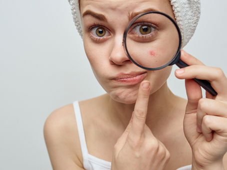 My acne client was doing great but suddenly her breakouts have seriously flared up!