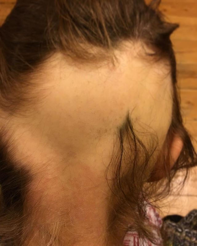 Does anyone else with alopecia have rash