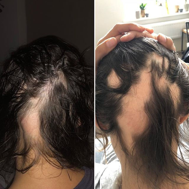 Hairloss is so random, so many reasons f