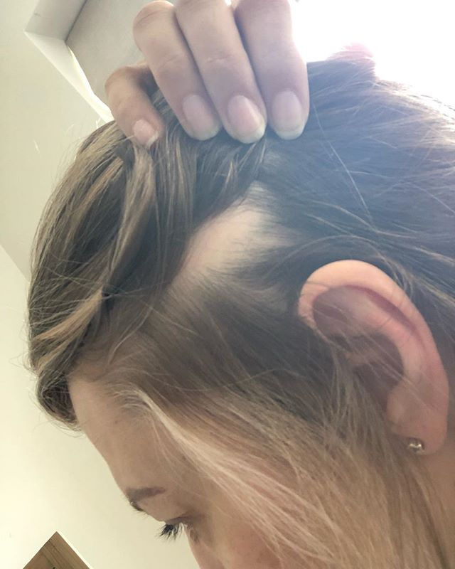 Still an awful lot of bald ness back the