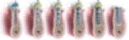 Dental Implants phuket