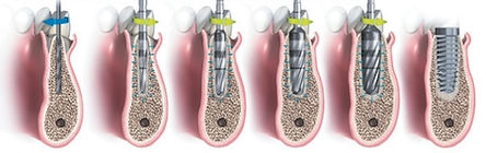 Dental Implants phuket