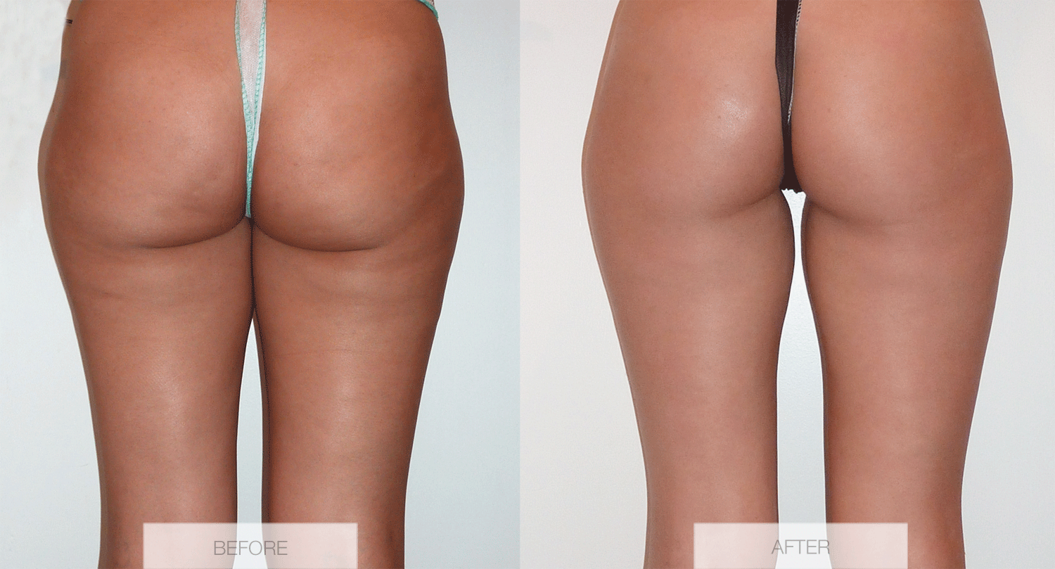 Real+before+and+after+cellulite+pictures
