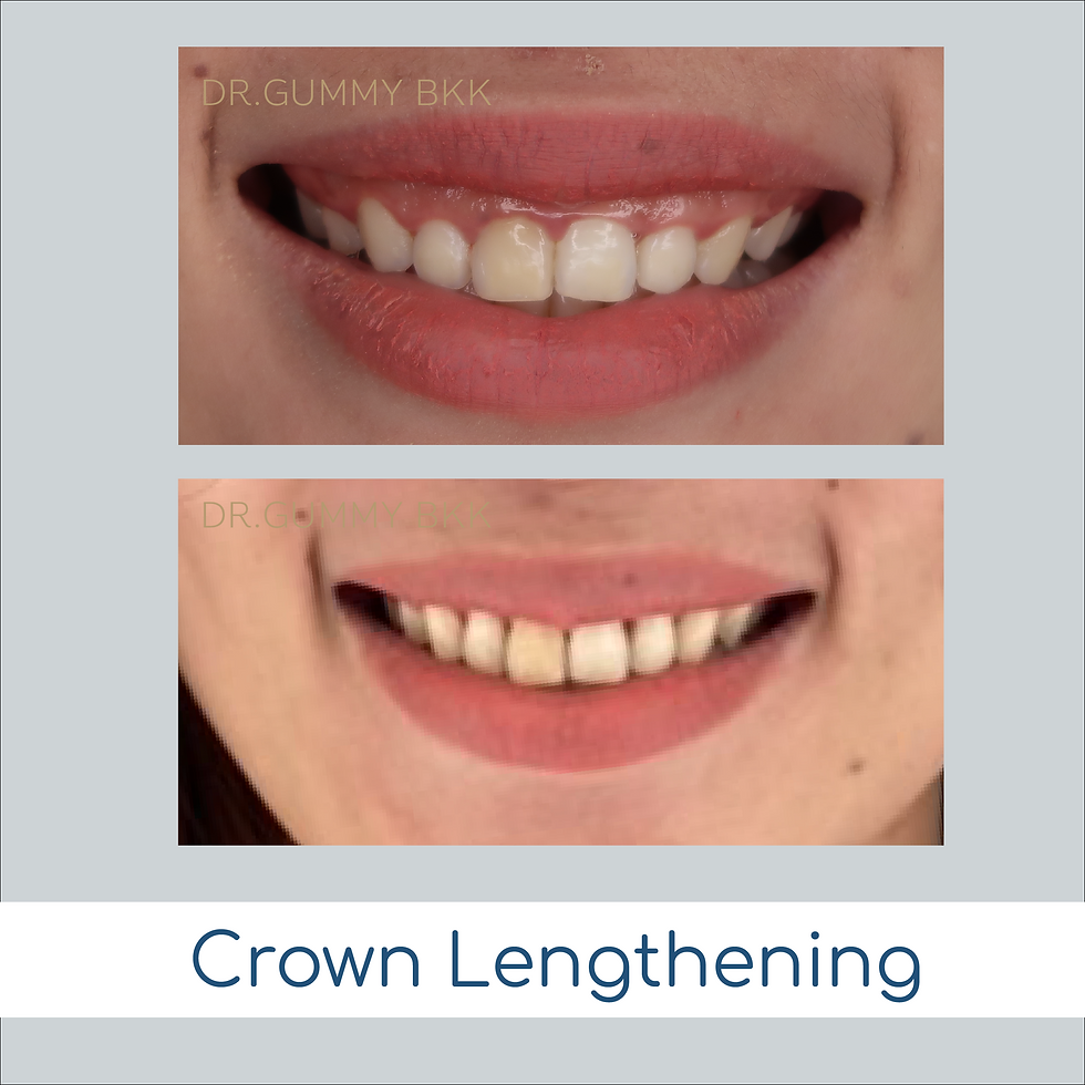 Crown Lengthening ร่นคอฟัน