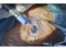 Todo un éxito macro jornada de más de mil cirugías de cataratas: IMSS