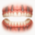 All on X Procedure - Toothhab.png