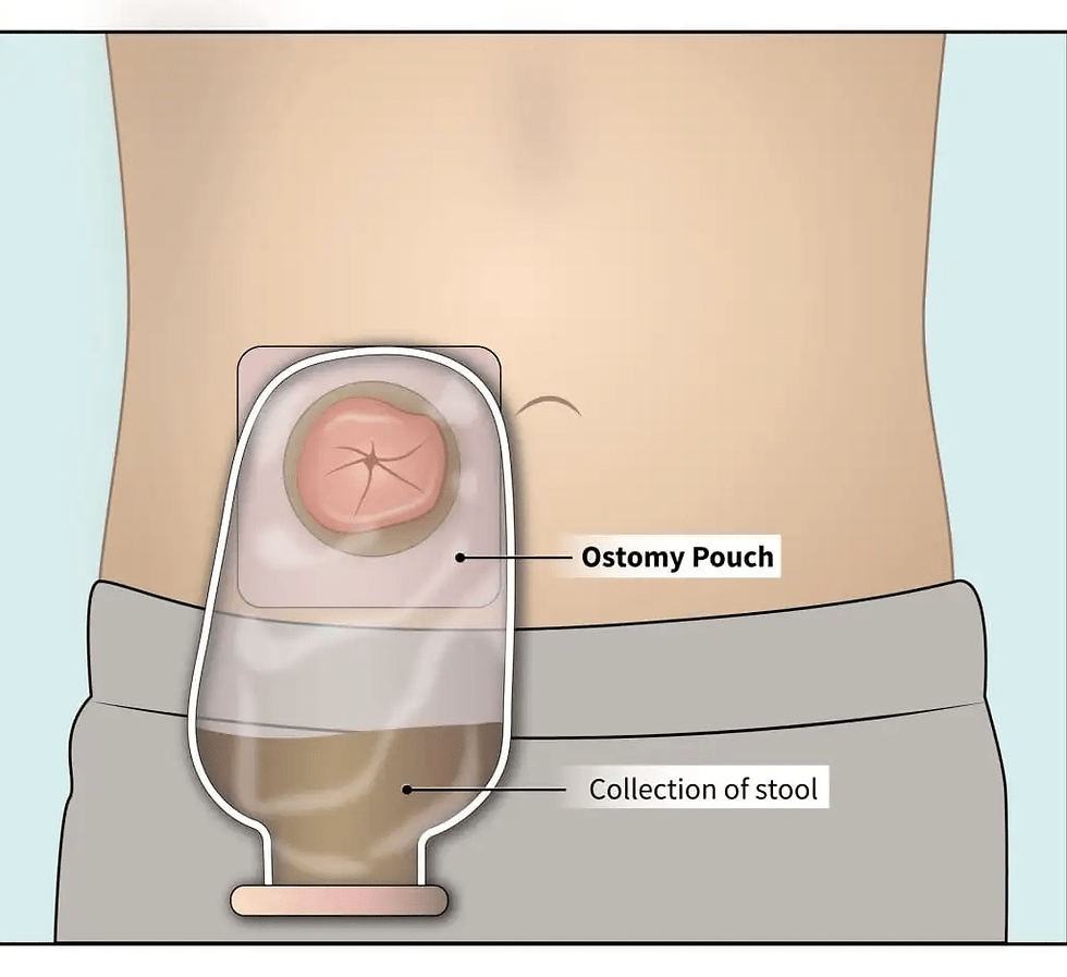 Diagram of a torso with an ostomy pouch attached. Labels indicate "Ostomy Pouch" and "Collection of stool" in a medical context.