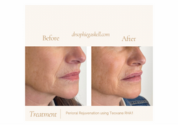 Lip Augmentation usingnTeoxane RHA2 (A4 (Landscape)) - 3