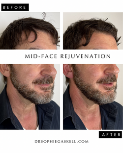 mid-face rejuvenation - 2