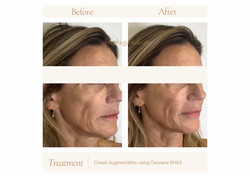 Lip Augmentation usingnTeoxane RHA2 (A4 (Landscape)) - 8