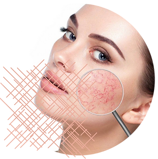 Vascular Lesions Removal.png