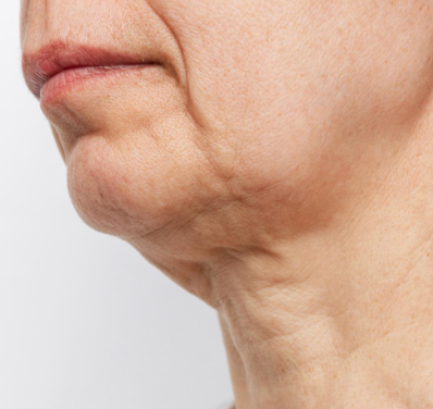 jawline-definition-liposuction