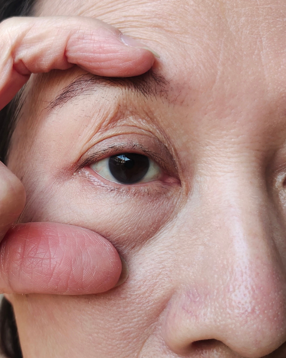 Upper blepharoplasty