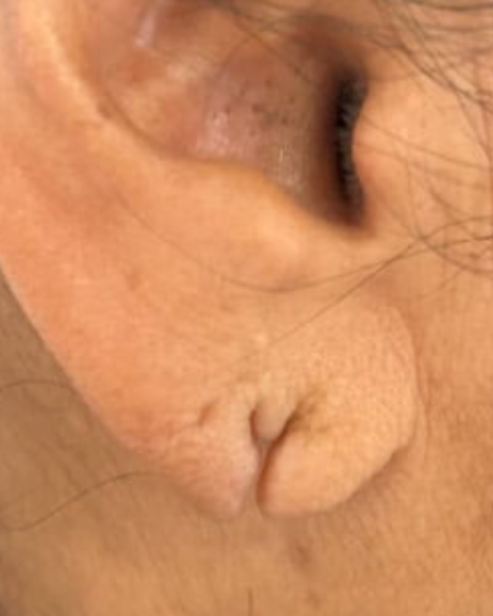 ear-lobe-reconstruction-zig-zag-scar