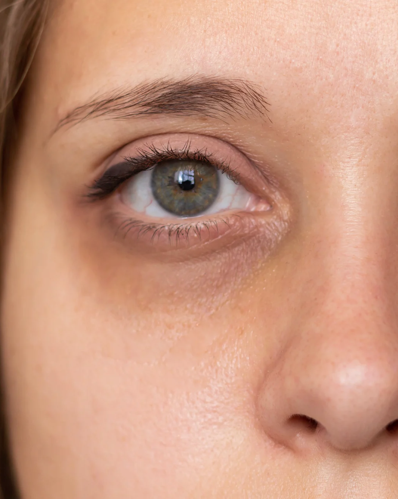 eye-rejuvenation-the-wilson-clinic