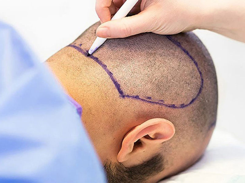 hair transplant (1)