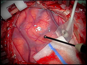 Function preservation during brain surgery