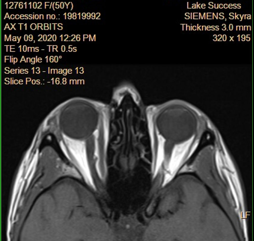 My orbital MRI May 2020- This is what graves disease looks like from the inside.
