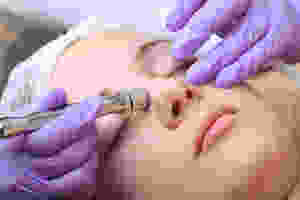 Tratament microdermabraziune