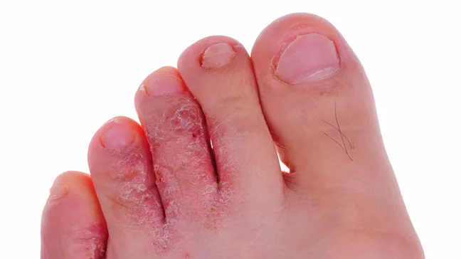 athletes_foot_toe.webp