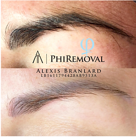 Détatouage PhiRemoval