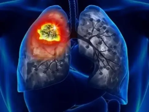 Anvisa avalia novo tratamento para câncer de pulmão