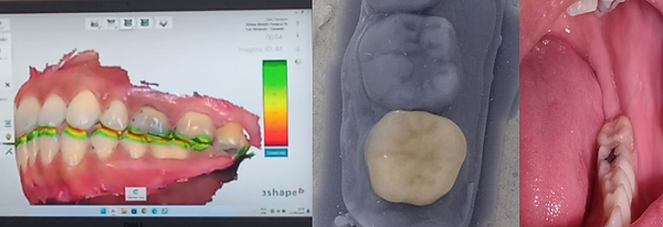 Planejamento digital e confecção de coroa dentária