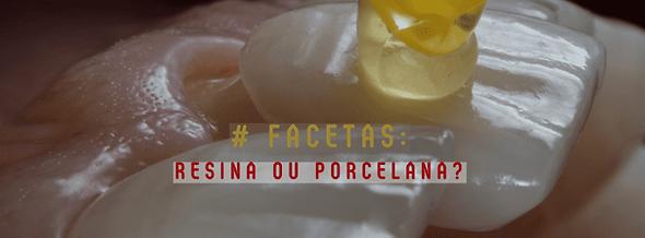 Facetas: Resina ou Porcelana?