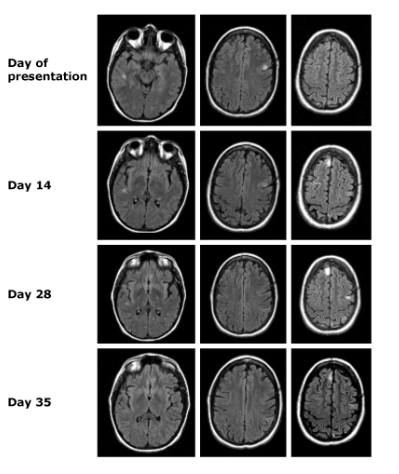 Cambios periictales migratorios: Una historia contada en FLAIR. Serie de imágenes FLAIR de una paciente de 28 años con crisis parciales recurrentes y enfermedad mitocondrial. La primera fila muestra hallazgos al momento de la presentación, seguidos de progresiones dinámicas en los días 14, 28 y 35. Los cambios migratorios destacan cómo las convulsiones multifocales pueden dejar su huella, recordándonos que en radiología, la evolución temporal es tan crucial como el diagnóstico inicial. ¡El cerebro habla y FLAIR nos traduce su historia! Cole, AJ. Status epilepticus and periictal imaging. Epilepsia 2004; 45 Suppl 4:72.