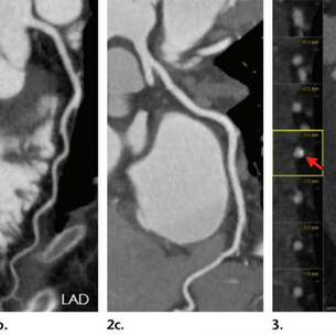 CAD-RADS en Radiología: Optimizando la Evaluación de la Enfermedad Coronaria