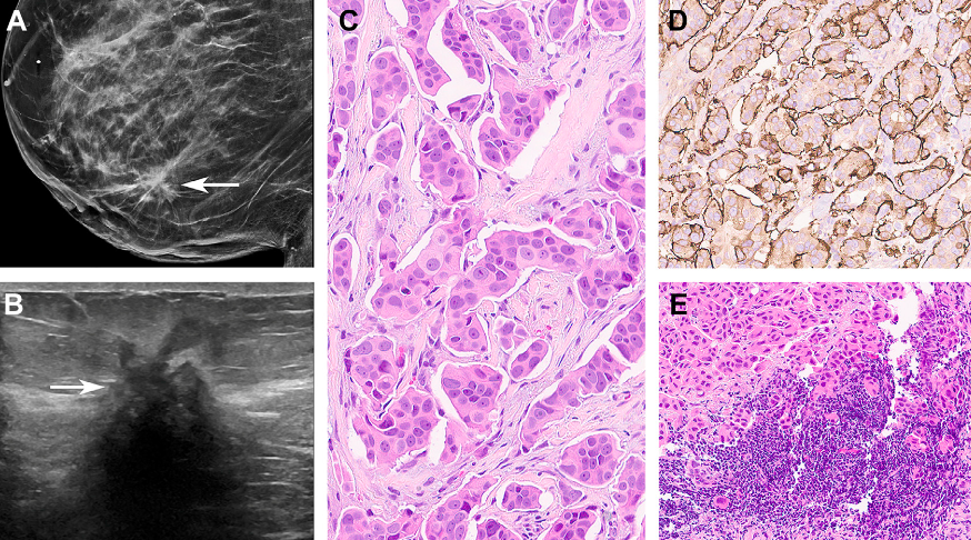 3. Carcinoma micropapilar invasor. Mujer de 63 años con nódulo palpable en mama derecha. (A) Mastografía diagnóstica (proyección medio-lateral) evidencia masa irregular con márgenes espiculados en mama derecha a las 4 en profundidad media y retracción del pezón. (B) Ultrasonido muestra masa hipoecoica irregular, de márgenes indistintos y marcada sombra acústica posterior. (C–E) Biopsia reveló carcinoma mamario invasor con rasgos micropapilares, grado 2 (ER+, PR+, HER2 dudoso en IHQ, sin amplificación por hibridación in situ, Ki-67 20%). Histología: grupos celulares en espacios vacíos con polaridad invertida, resaltados por EMA en membrana periférica. Se documentó metástasis ganglionar axilar extensa.