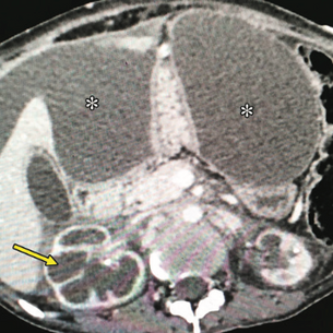 Granulomas en Abdomen y Pelvis: El Gran Imitador en Imágenes