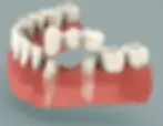 Dentures, Chipped Tooth, Orthodontics