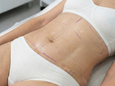 Lipo Hd, Clínica CEYS