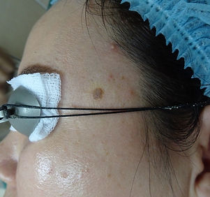 Seborrheic keratosis2.jpg