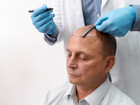 Factors That Impact Hair Transplant Price Disparities
