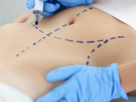 Sculpting Success: Real Stories of Liposuction Triumphs in Dubai