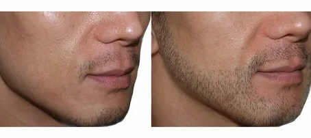 Dubai's Beard Hair Transplant Boom: What You Need to Know