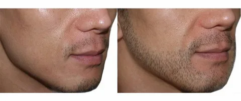 زراعة شعر اللحية في دبي