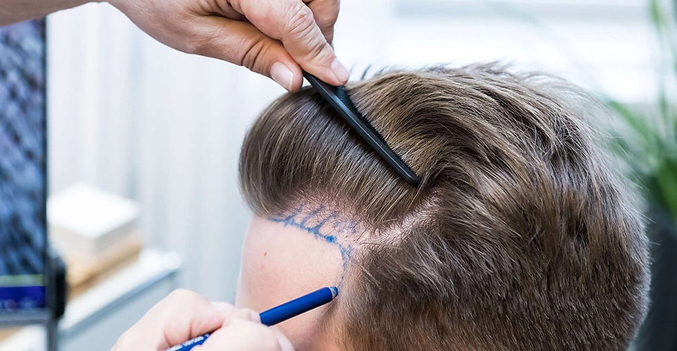 Common Myths About Hair Transplant in Dubai