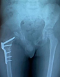 perthes xray_edited.png